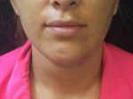 Liposuction Under Chin