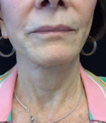 Incisionless Necklifts