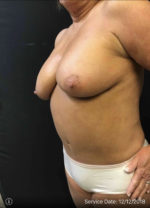 Fat Grafting to Breast
