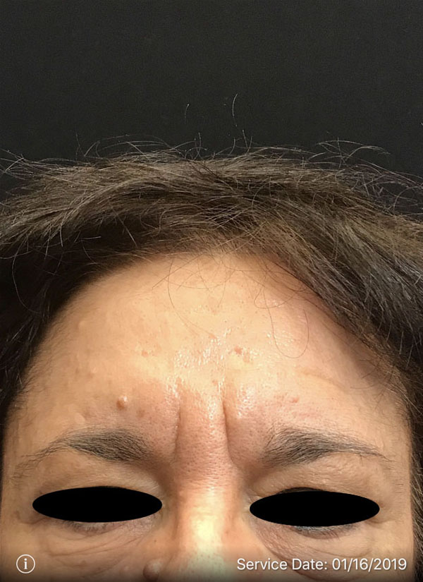 Around The Eye Fillers