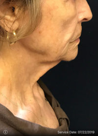 Nonsurgical Lift