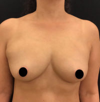 Fat Grafting to Breast