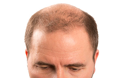 male pattern baldness