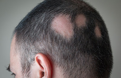 man with patchy hair loss