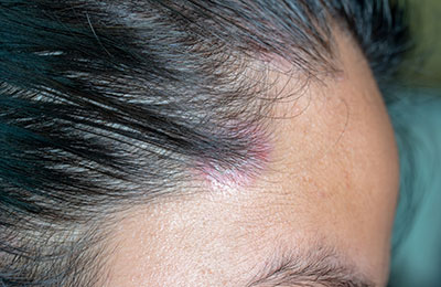 woman with scalp fungus